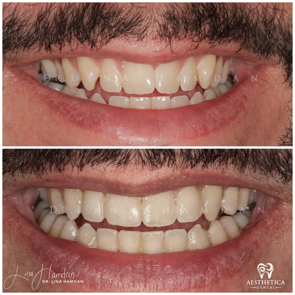 Clear aligners, quietly handled: anonymous case 20 from Aesthetica Dental Naperville