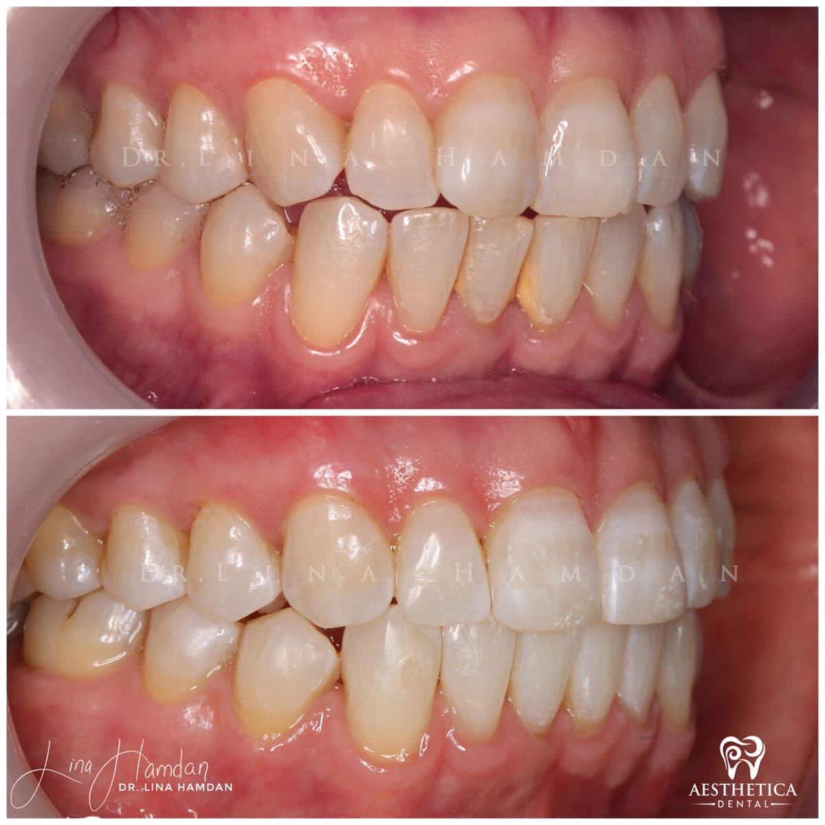 Clear aligners, quietly handled: anonymous case 21 from Aesthetica Dental Naperville