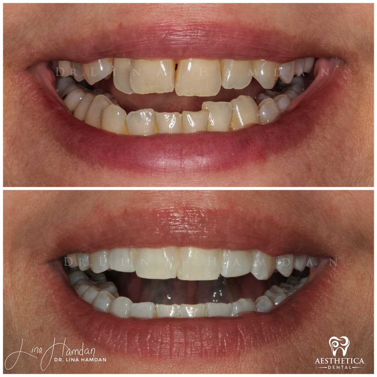 Clear aligners, quietly handled: anonymous case 23 from Aesthetica Dental Naperville