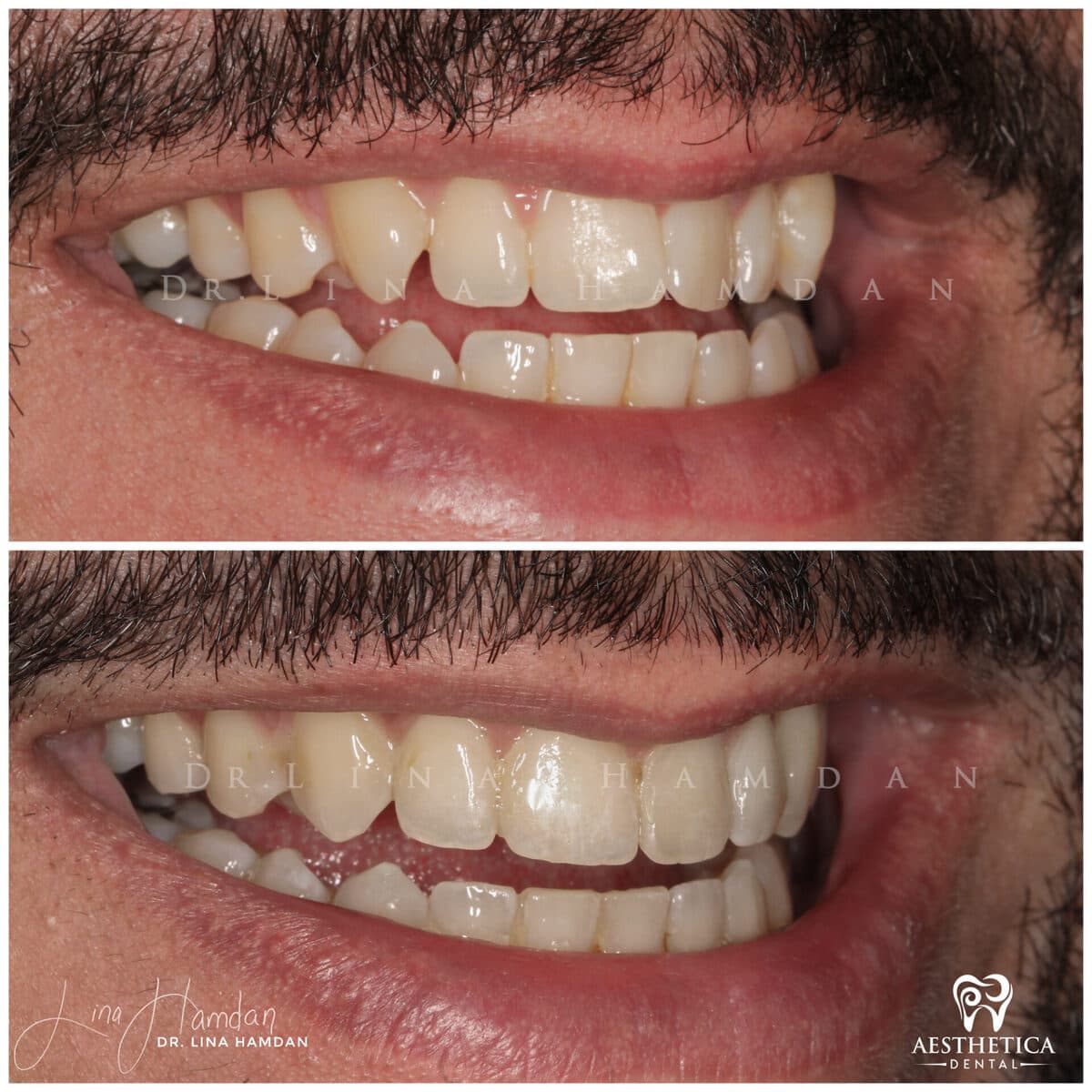 Clear aligners, quietly handled: anonymous case 24 from Aesthetica Dental Naperville