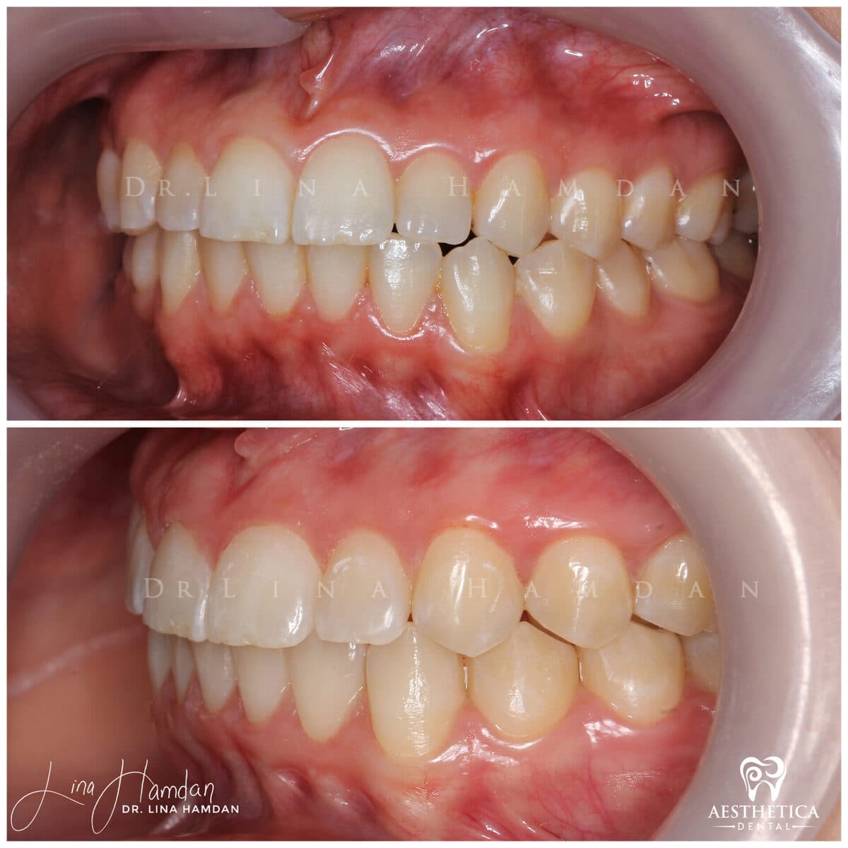 Clear aligners, quietly handled: anonymous case 26 from Aesthetica Dental Naperville