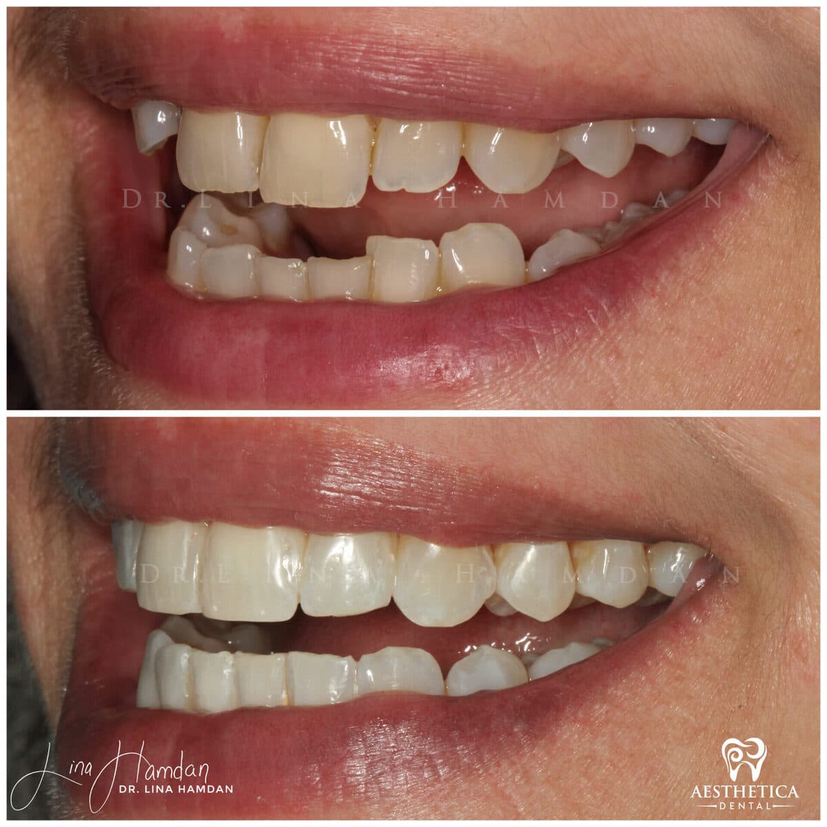 Clear aligners, quietly handled: anonymous case 34 from Aesthetica Dental Naperville