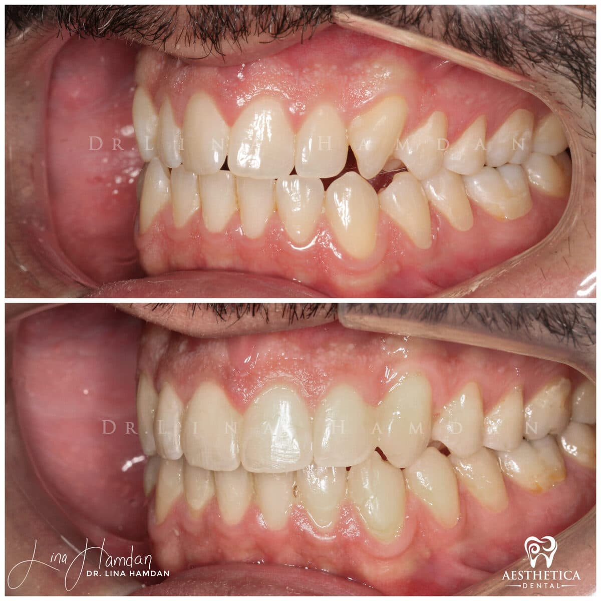 Clear aligners, quietly handled: anonymous case 35 from Aesthetica Dental Naperville