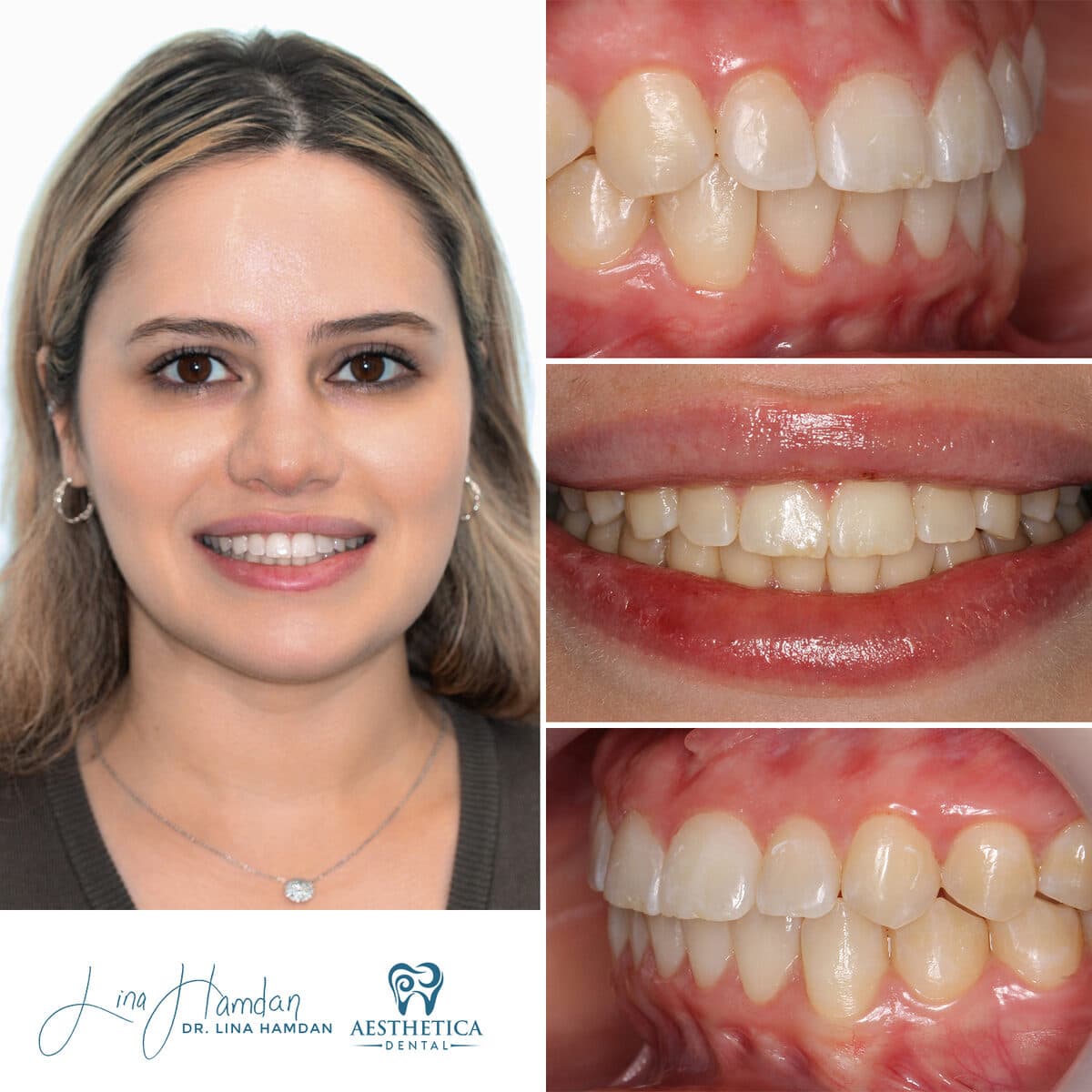 Clear aligners, quietly handled: anonymous case 39 from Aesthetica Dental Naperville