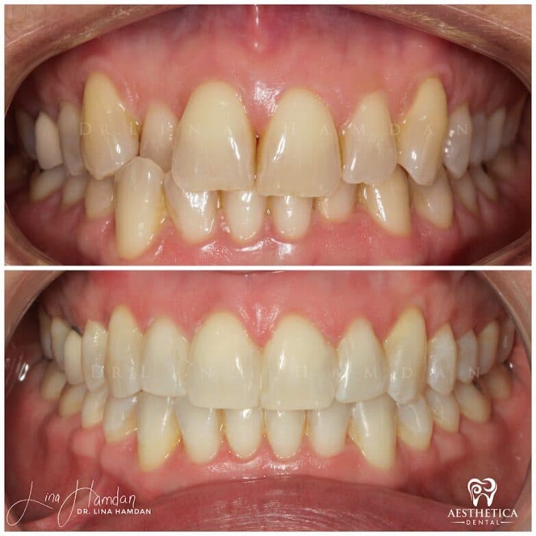 Clear aligners, quietly handled: anonymous case 40 from Aesthetica Dental Naperville