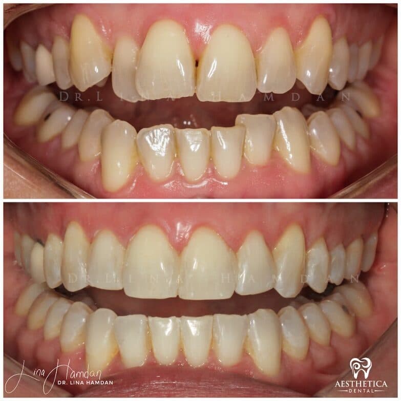Clear aligners, quietly handled: anonymous case 41 from Aesthetica Dental Naperville