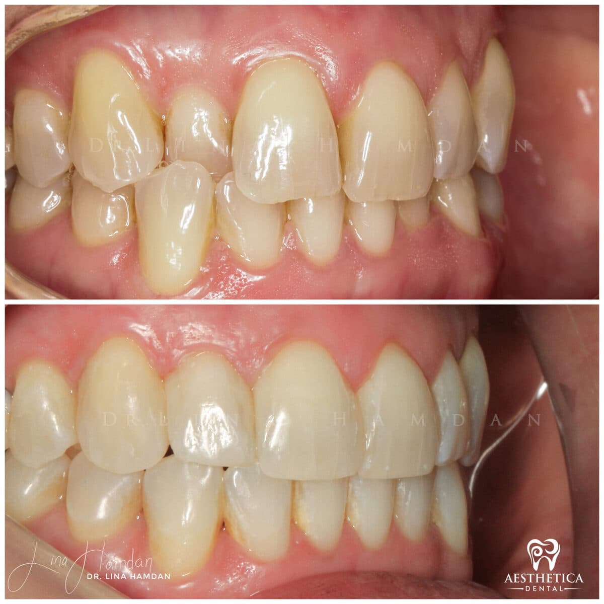 Clear aligners, quietly handled: anonymous case 42 from Aesthetica Dental Naperville