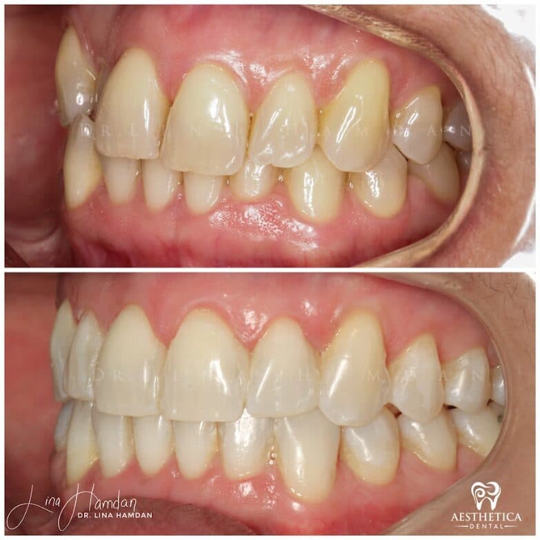 Clear aligners, quietly handled: anonymous case 45 from Aesthetica Dental Naperville