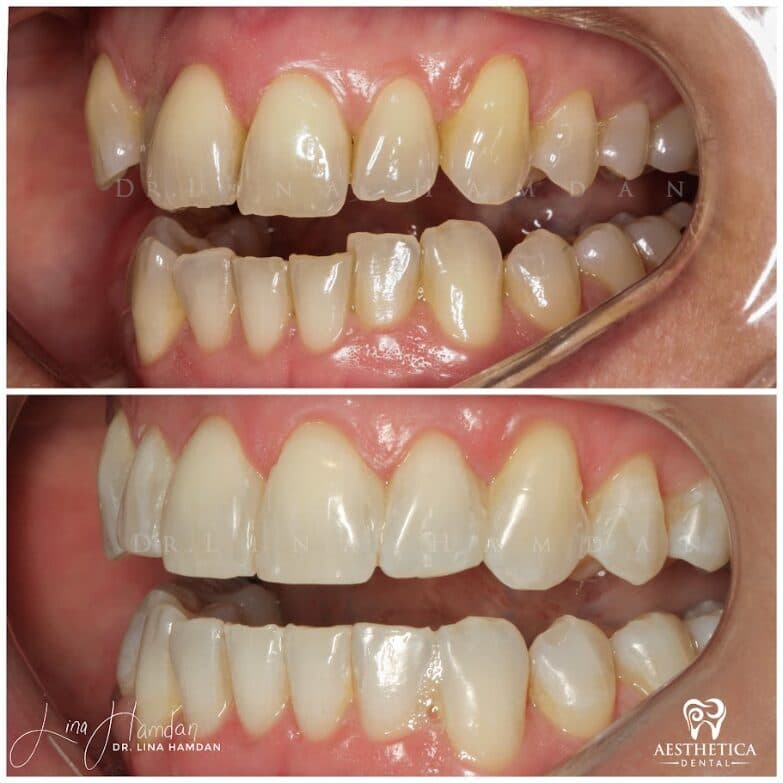 Clear aligners, quietly handled: anonymous case 46 from Aesthetica Dental Naperville