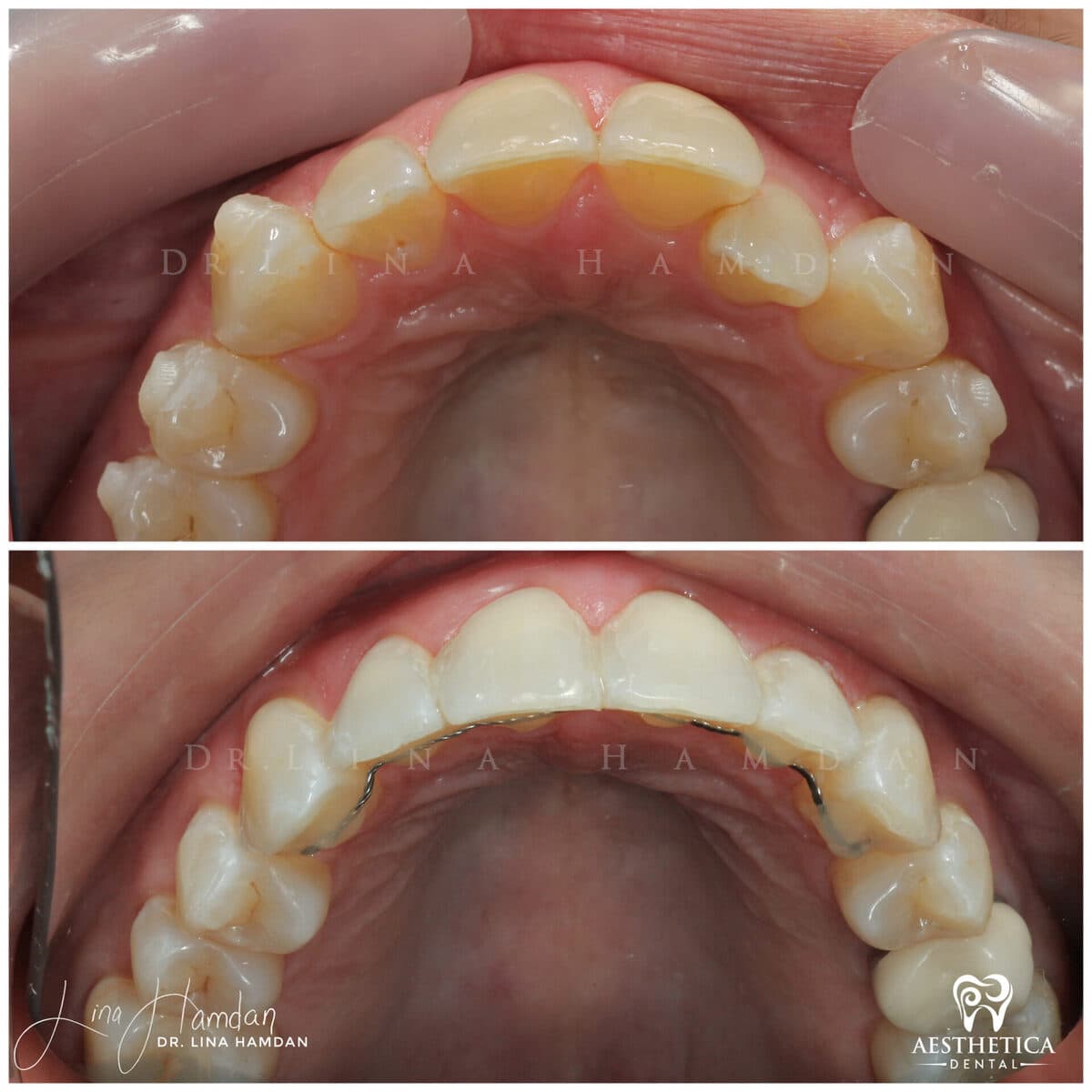 Clear aligners, quietly handled: anonymous case 47 from Aesthetica Dental Naperville
