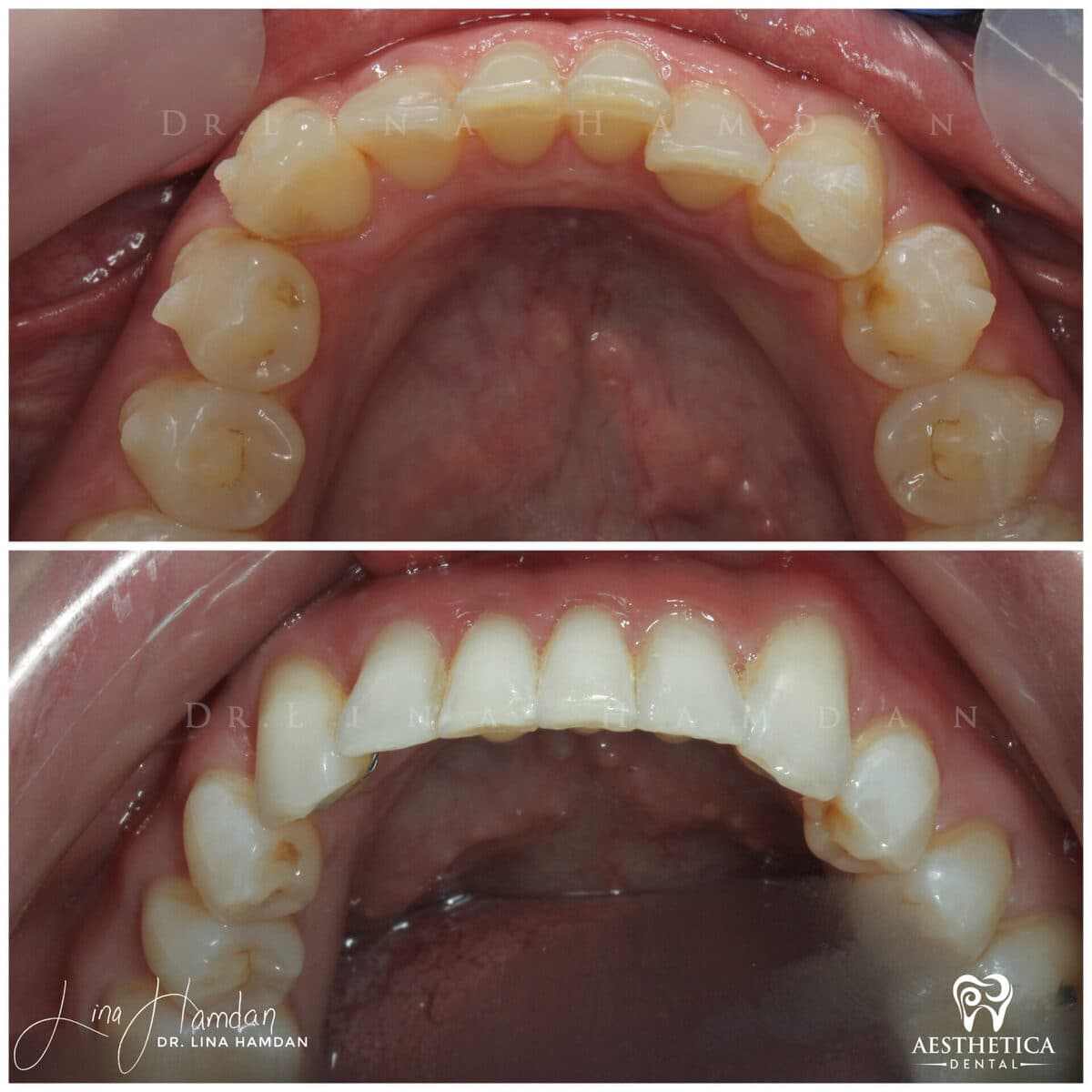 Clear aligners, quietly handled: anonymous case 49 from Aesthetica Dental Naperville
