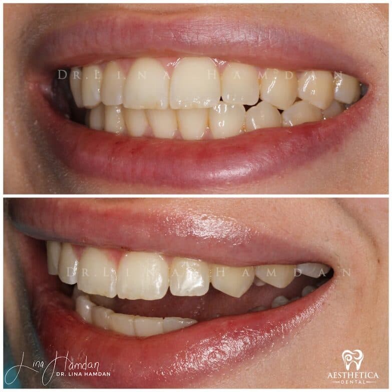 Clear aligners, quietly handled: anonymous case 52 from Aesthetica Dental Naperville
