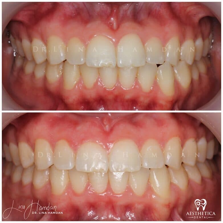 Clear aligners, quietly handled: anonymous case 53 from Aesthetica Dental Naperville