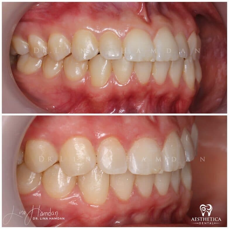 Clear aligners, quietly handled: anonymous case 57 from Aesthetica Dental Naperville