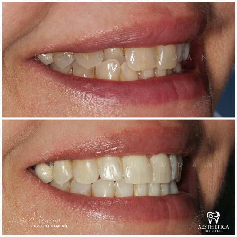 Clear aligners, quietly handled: anonymous case 58 from Aesthetica Dental Naperville