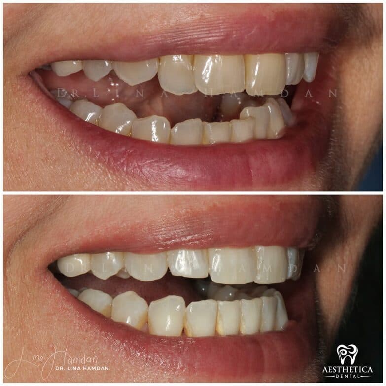 Clear aligners, quietly handled: anonymous case 59 from Aesthetica Dental Naperville