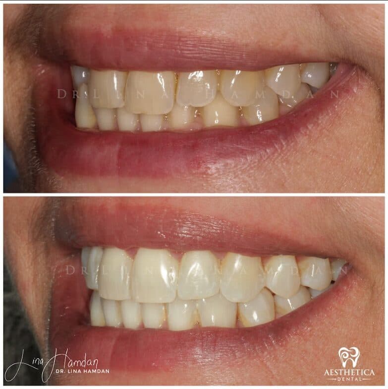 Clear aligners, quietly handled: anonymous case 60 from Aesthetica Dental Naperville