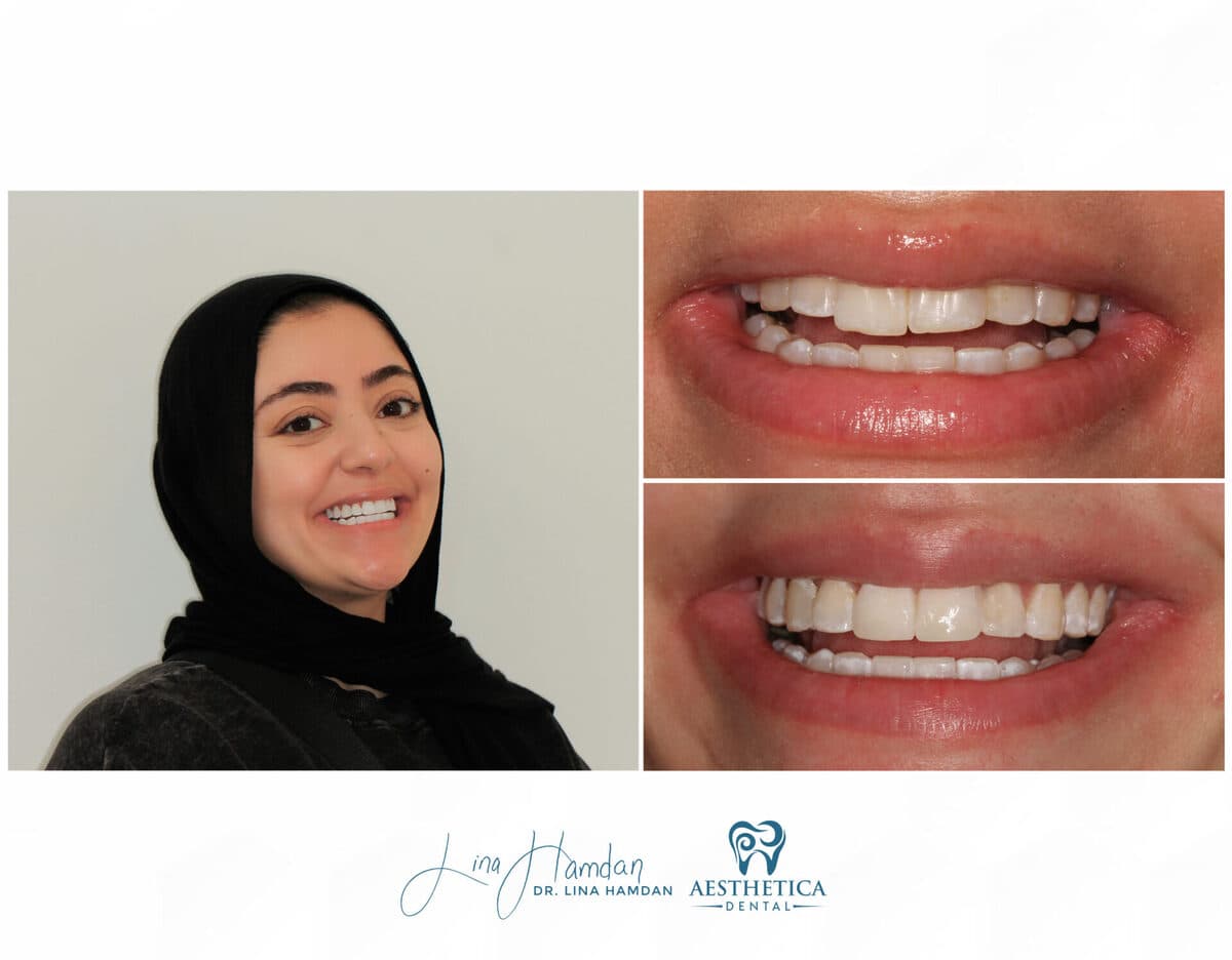 Clear aligners, quietly handled: anonymous case 63 from Aesthetica Dental Naperville
