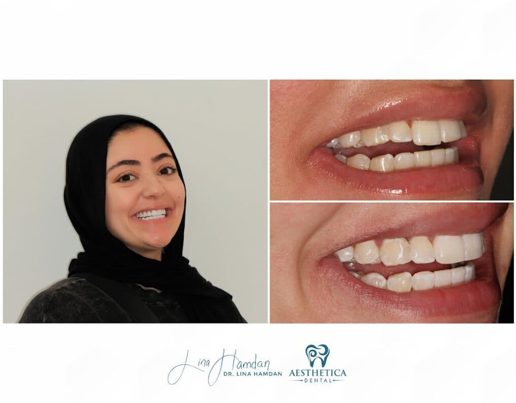 Clear aligners, quietly handled: anonymous case 65 from Aesthetica Dental Naperville