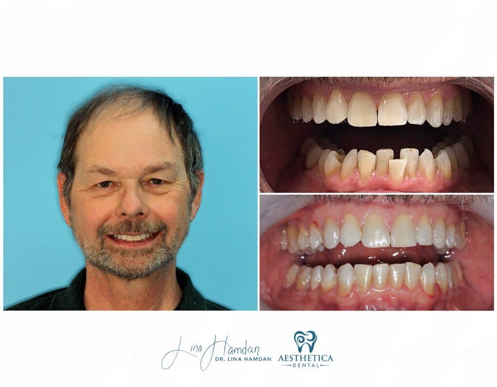 Clear aligners, quietly handled: anonymous case 66 from Aesthetica Dental Naperville