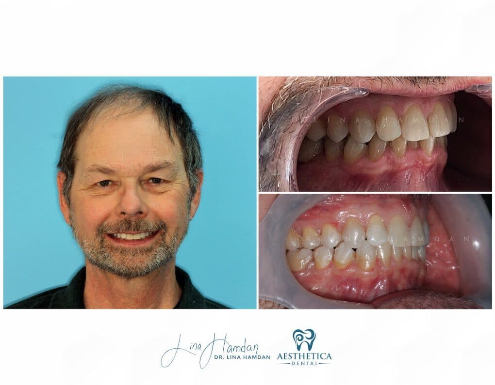 Clear aligners, quietly handled: anonymous case 69 from Aesthetica Dental Naperville
