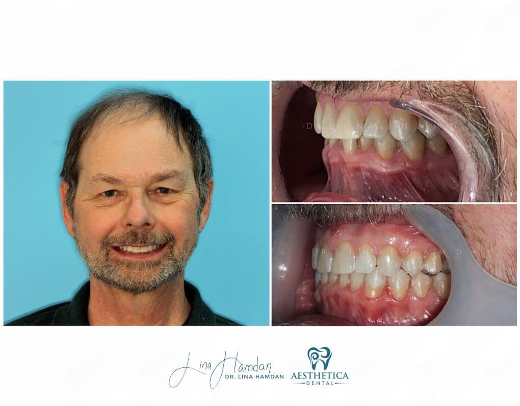 Clear aligners, quietly handled: anonymous case 70 from Aesthetica Dental Naperville