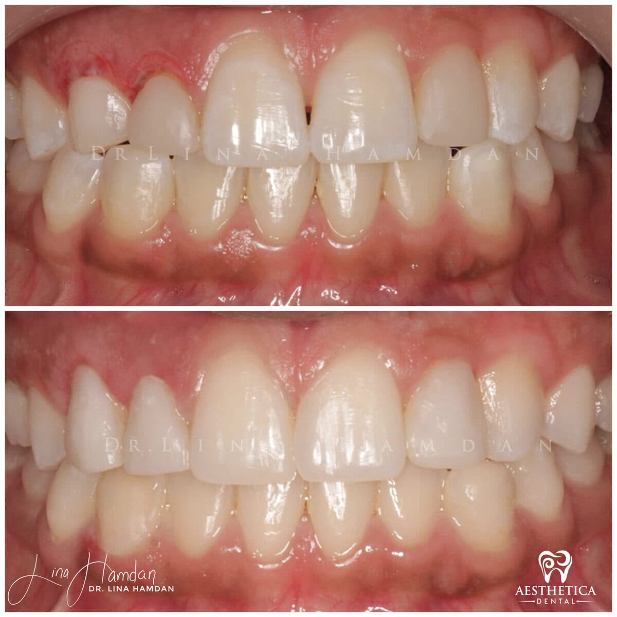 Periodontal treatment.: anonymous before-and-after case photograph from Aesthetica Dental Naperville