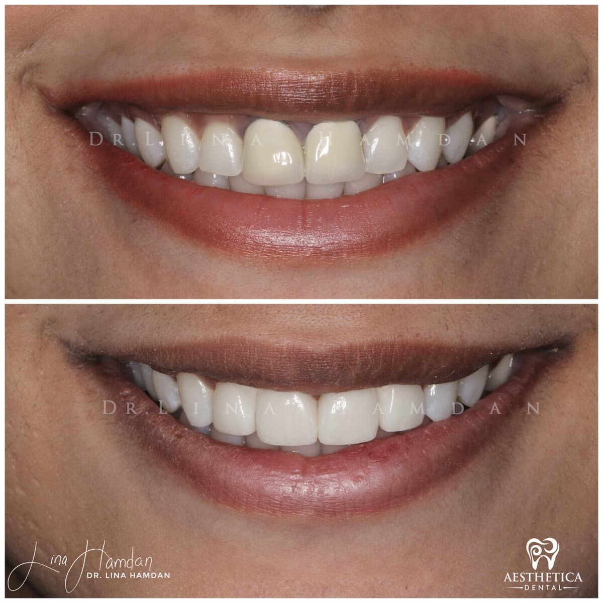 Considered porcelain veneers.: anonymous before-and-after case photograph from Aesthetica Dental Naperville