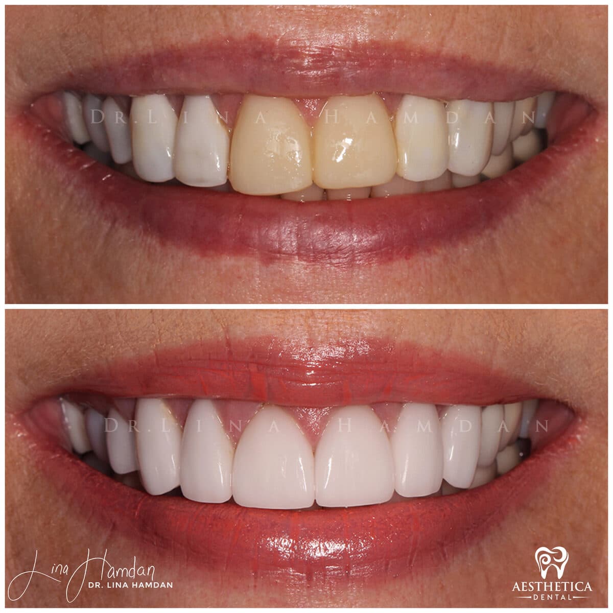 Porcelain veneers result, anonymous patient at Aesthetica Dental Naperville (case 3, 2025-01-1-12)