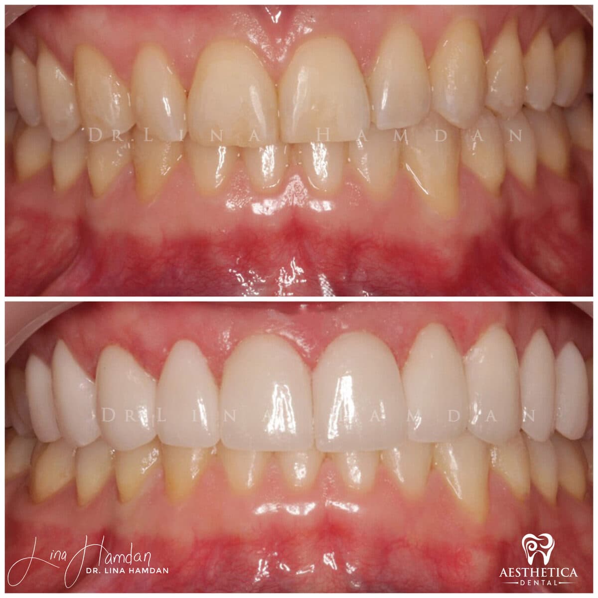 Porcelain veneers result, anonymous patient at Aesthetica Dental Naperville (case 4, 2025-01-1-13)