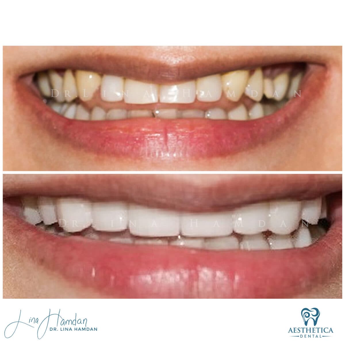 Porcelain veneers result, anonymous patient at Aesthetica Dental Naperville (case 8, 2025-01-1-17)