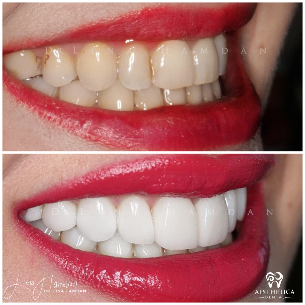 Porcelain veneers result, anonymous patient at Aesthetica Dental Naperville (case 10, 2025-01-1-19)