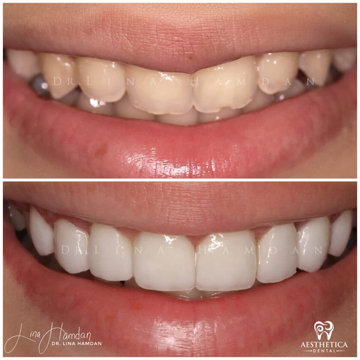 Porcelain veneers result, anonymous patient at Aesthetica Dental Naperville (case 11, 2025-01-1-20)