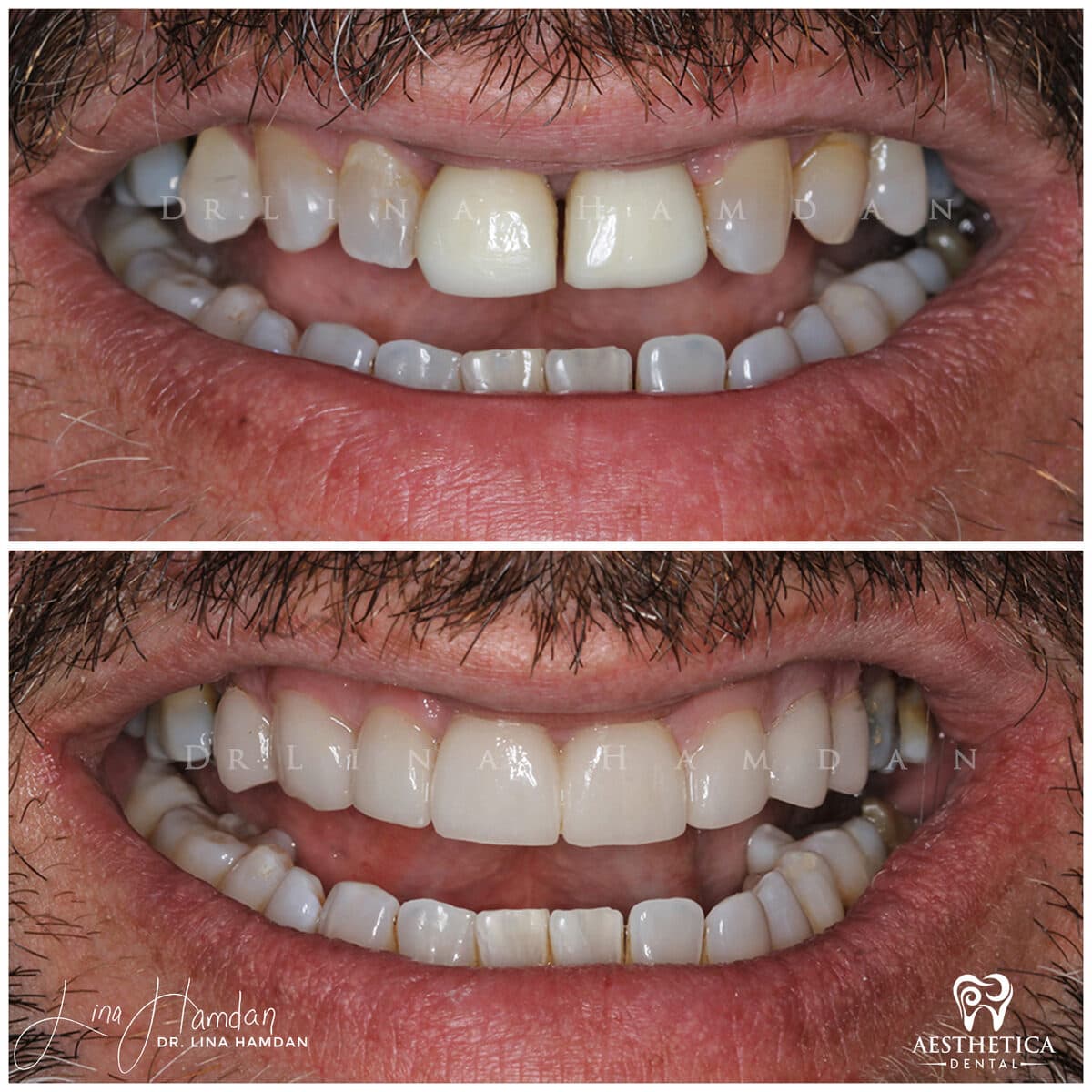 Considered porcelain veneers: anonymous case 13 from Aesthetica Dental Naperville