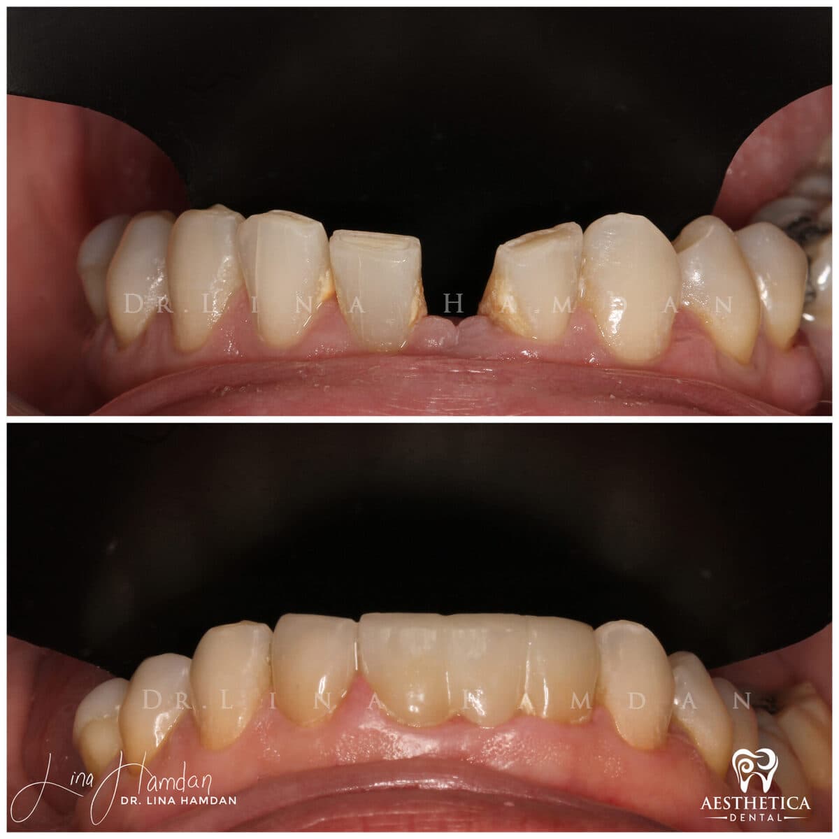 Considered porcelain veneers: anonymous case 19 from Aesthetica Dental Naperville