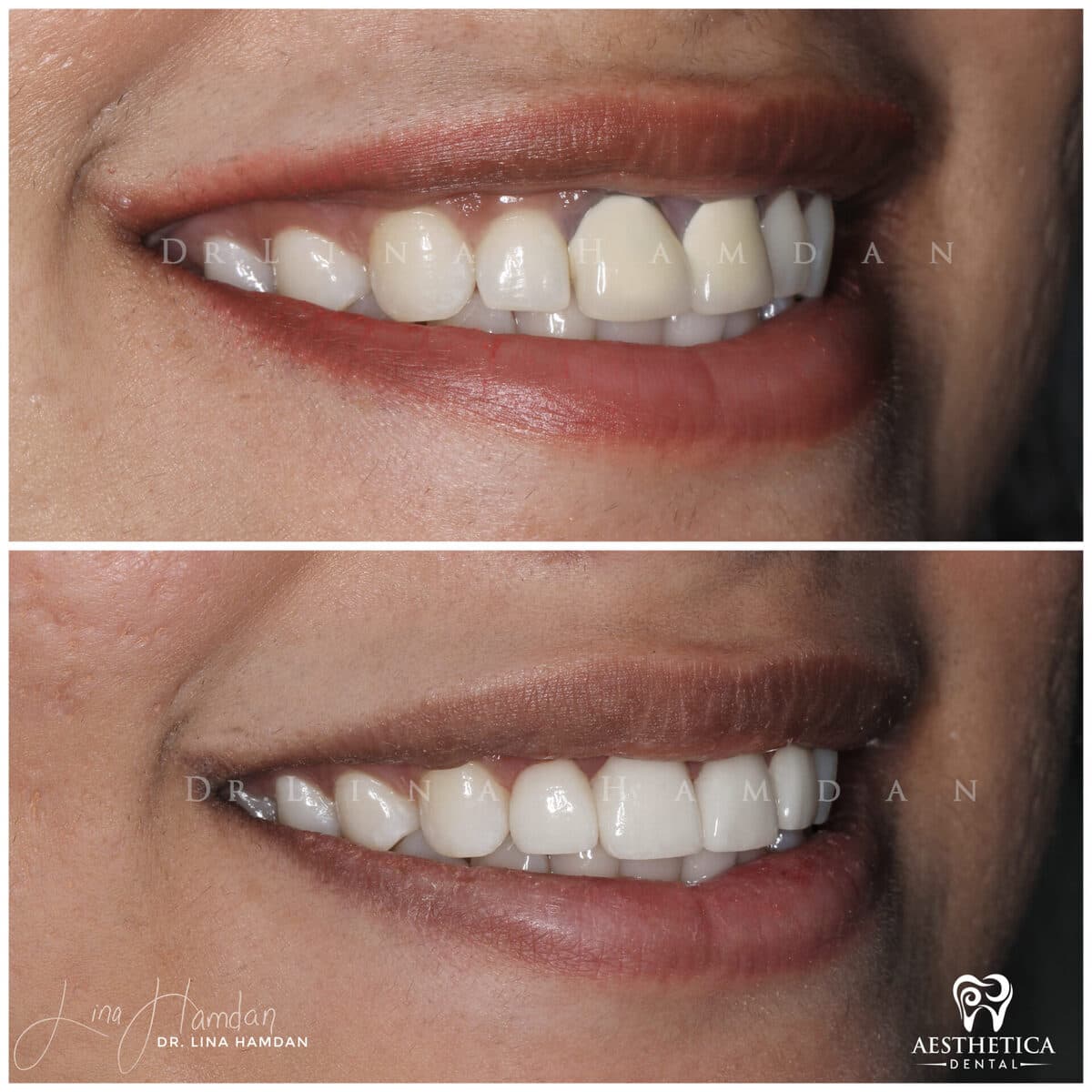 Considered porcelain veneers: anonymous case 21 from Aesthetica Dental Naperville