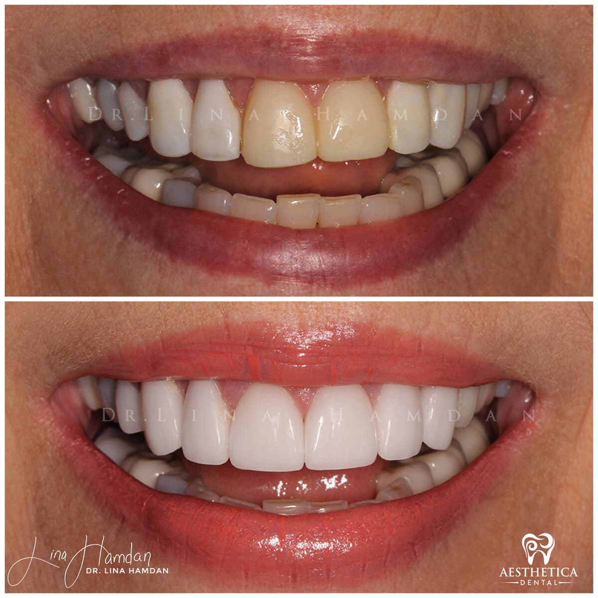 Considered porcelain veneers: anonymous case 23 from Aesthetica Dental Naperville