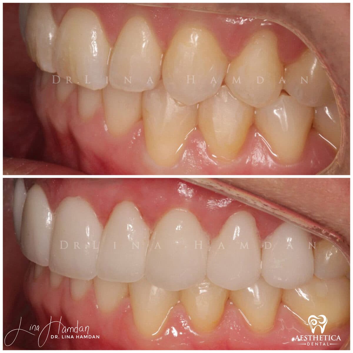 Considered porcelain veneers: anonymous case 24 from Aesthetica Dental Naperville