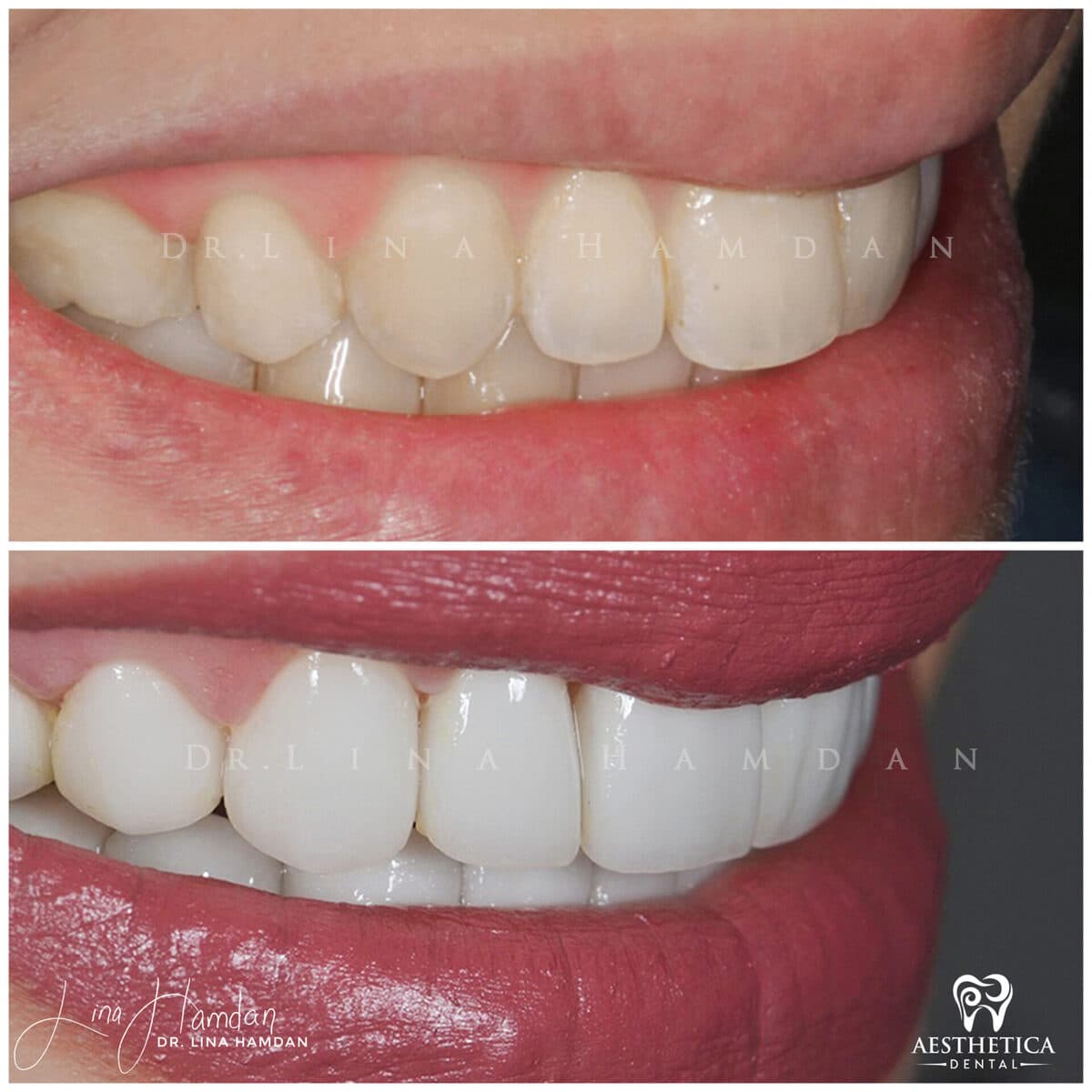 Considered porcelain veneers: anonymous case 32 from Aesthetica Dental Naperville