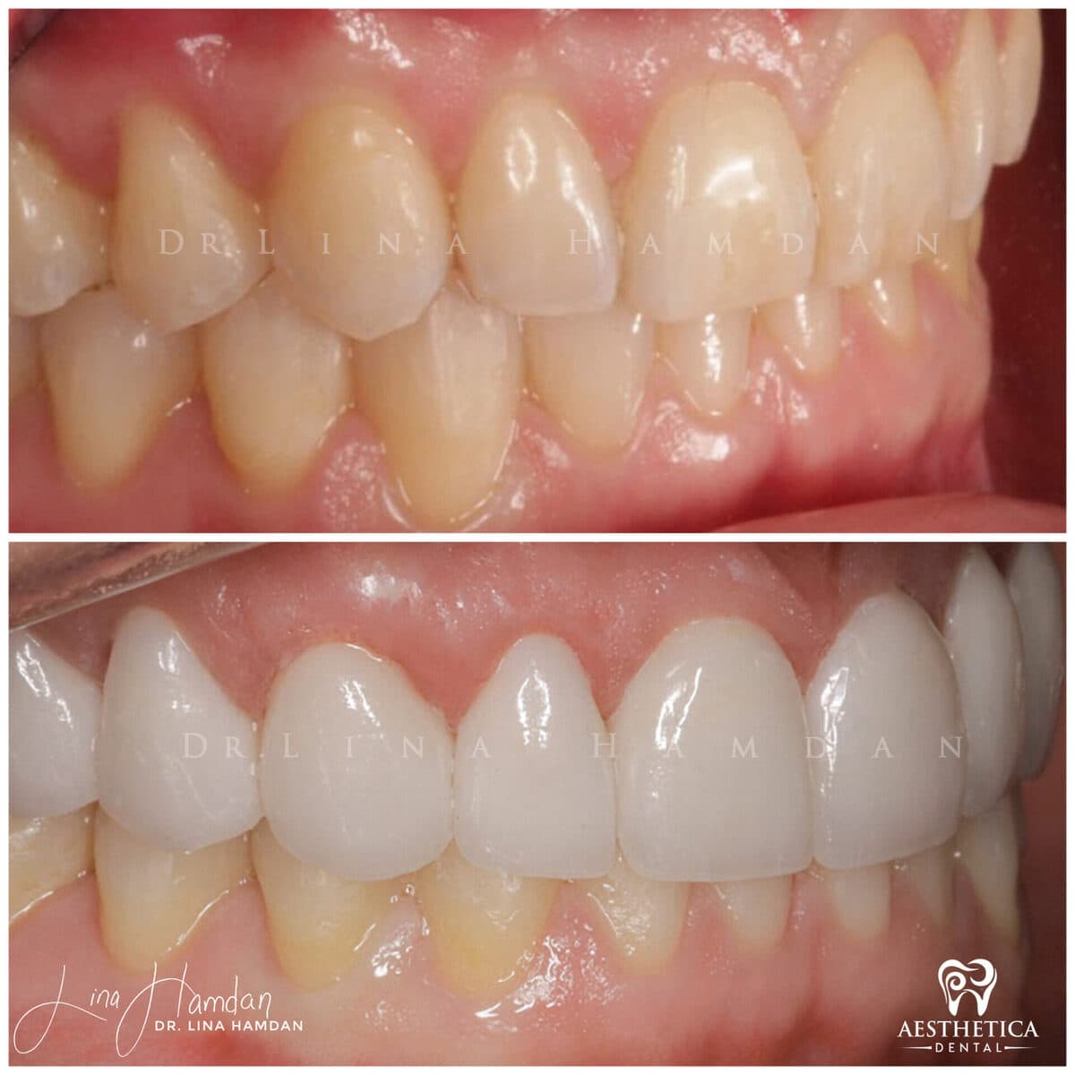 Considered porcelain veneers: anonymous case 34 from Aesthetica Dental Naperville