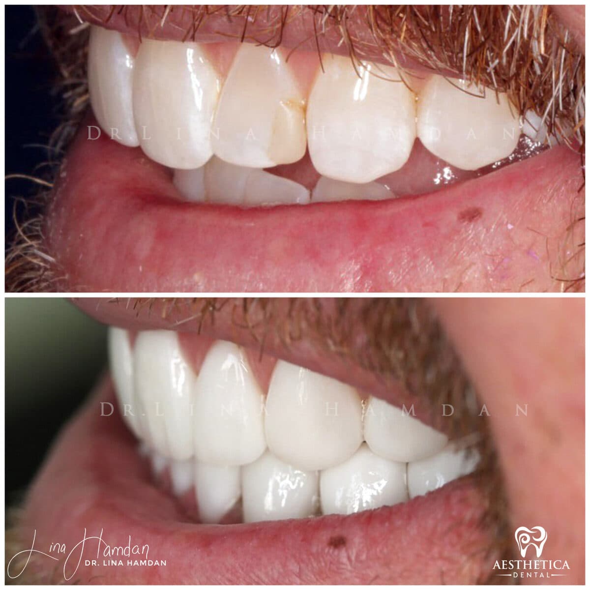 Considered porcelain veneers: anonymous case 36 from Aesthetica Dental Naperville