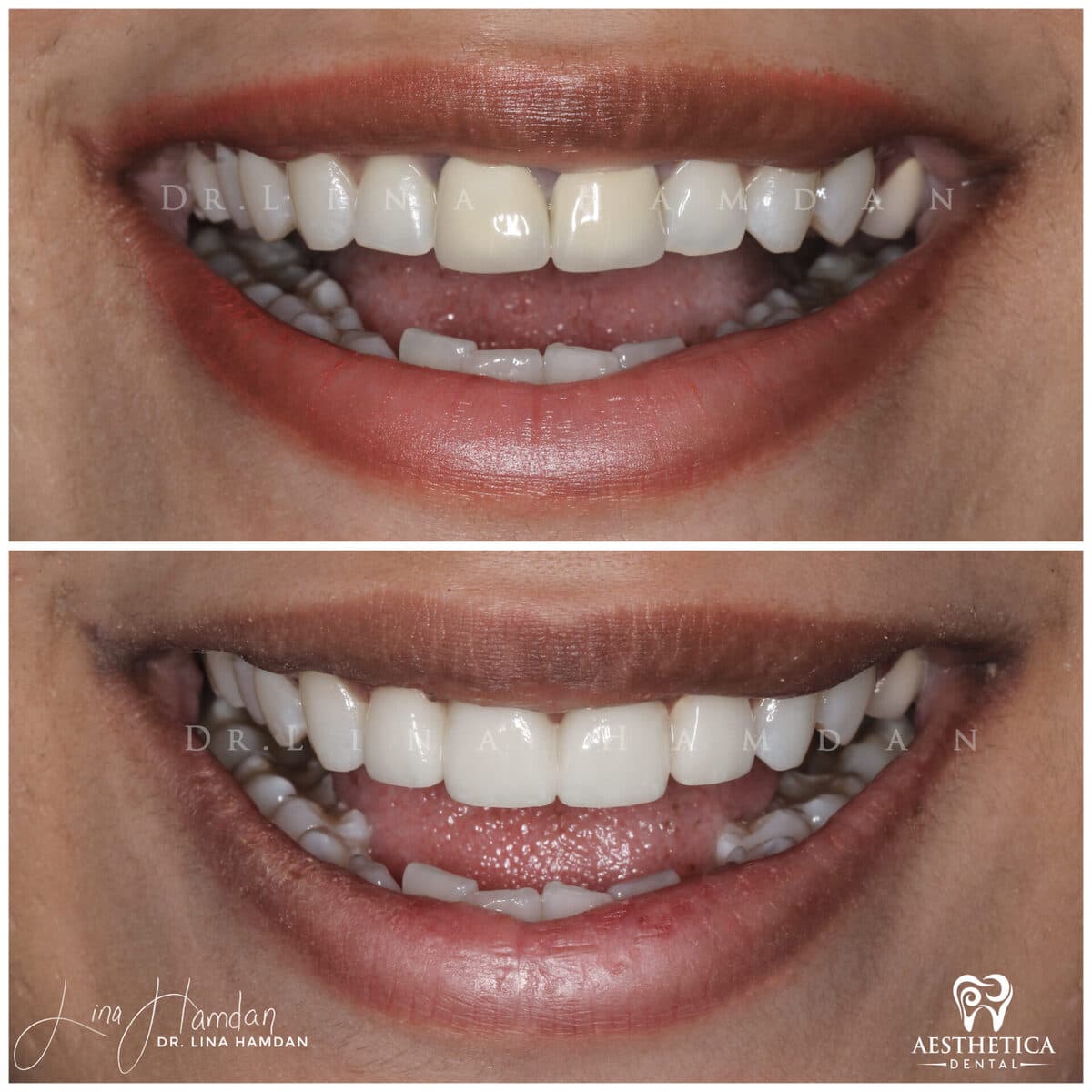 Considered porcelain veneers: anonymous case 39 from Aesthetica Dental Naperville