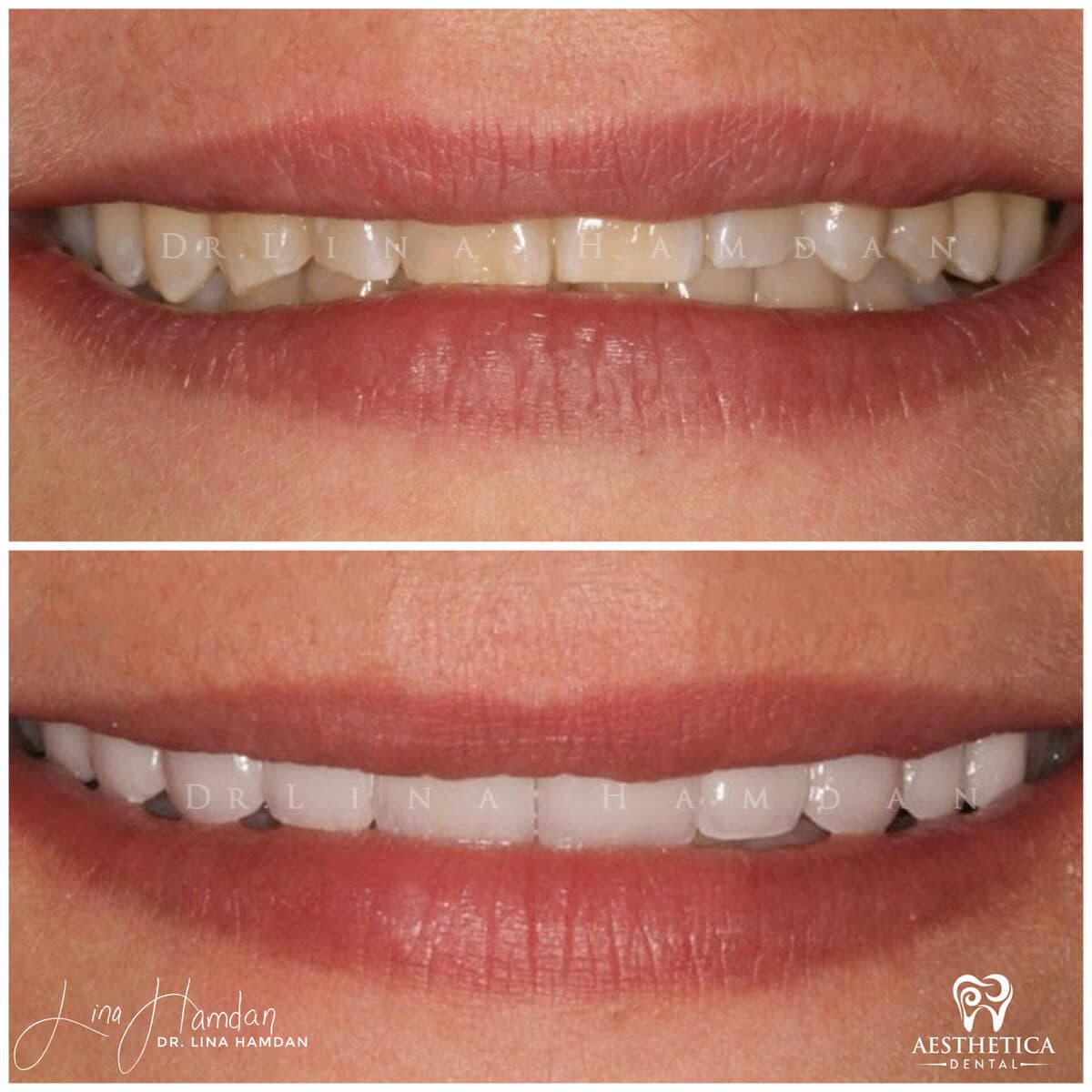 Considered porcelain veneers: anonymous case 42 from Aesthetica Dental Naperville