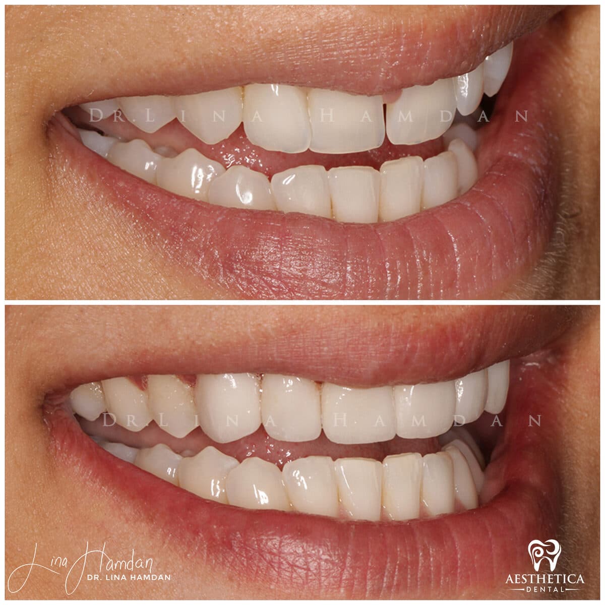 Considered porcelain veneers: anonymous case 43 from Aesthetica Dental Naperville