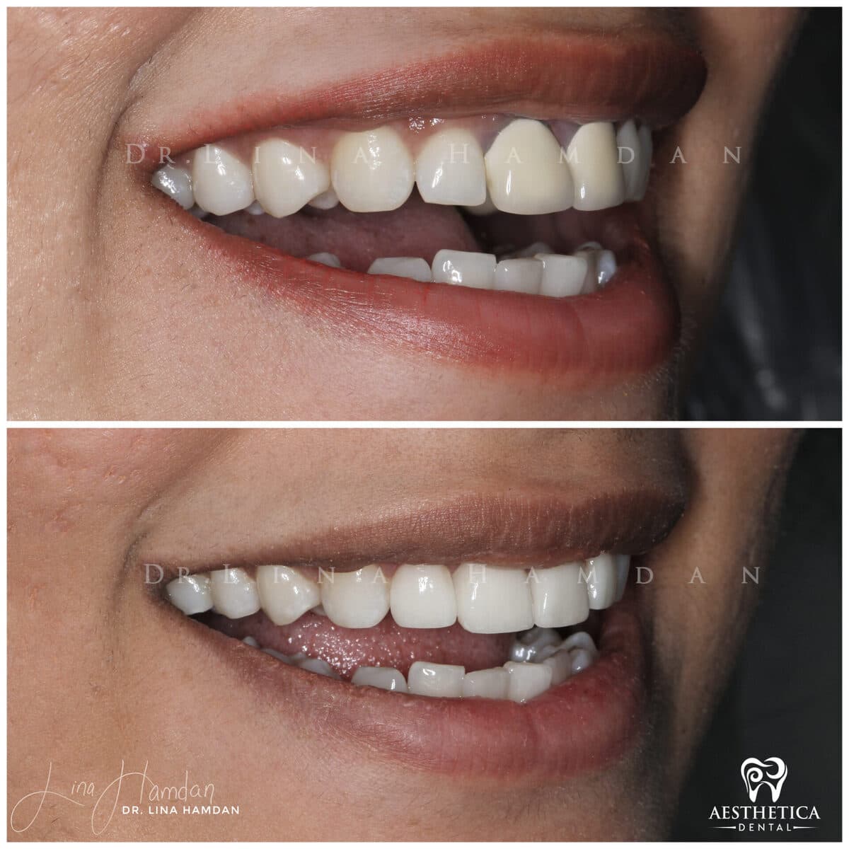 Considered porcelain veneers: anonymous case 46 from Aesthetica Dental Naperville