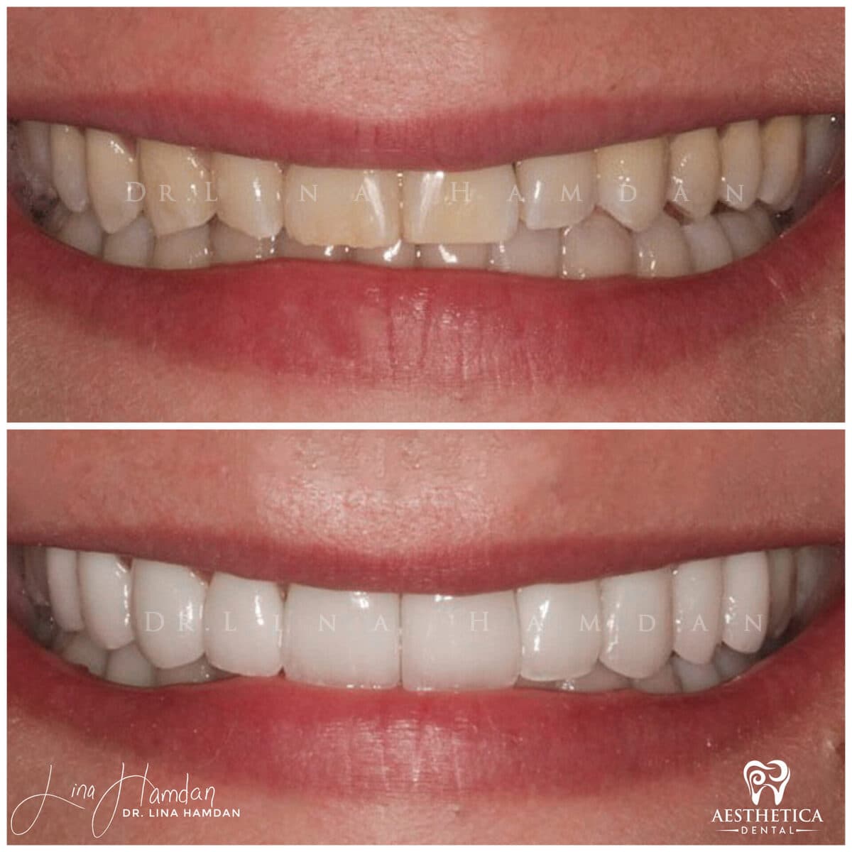 Considered porcelain veneers: anonymous case 48 from Aesthetica Dental Naperville