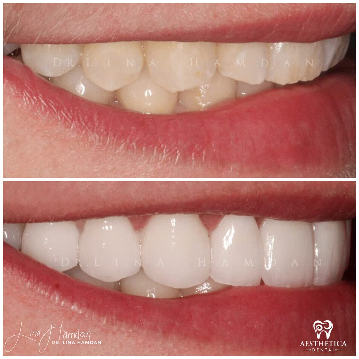 Considered porcelain veneers: anonymous case 49 from Aesthetica Dental Naperville
