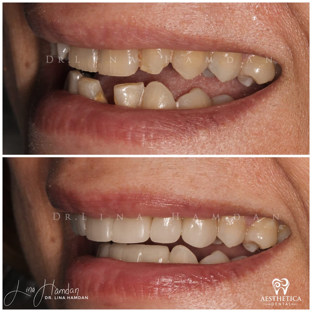 Considered porcelain veneers: anonymous case 51 from Aesthetica Dental Naperville