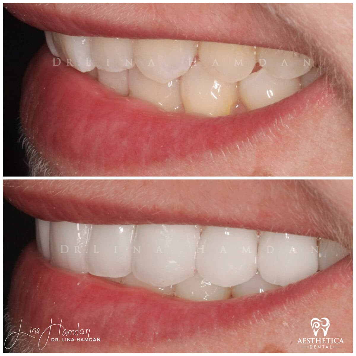 Considered porcelain veneers: anonymous case 54 from Aesthetica Dental Naperville