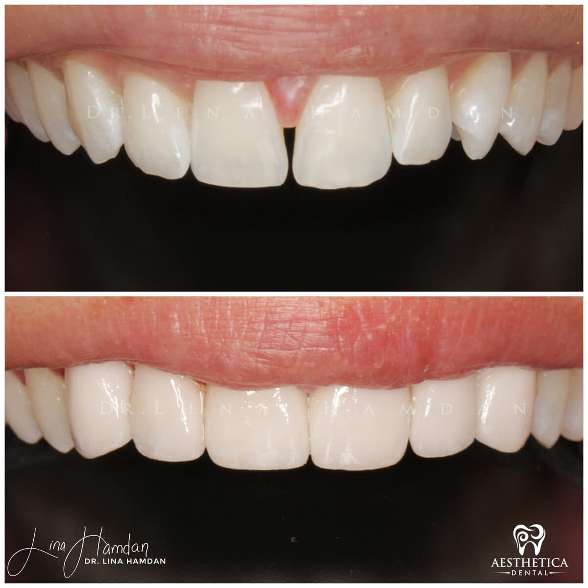 Considered porcelain veneers: anonymous case 55 from Aesthetica Dental Naperville